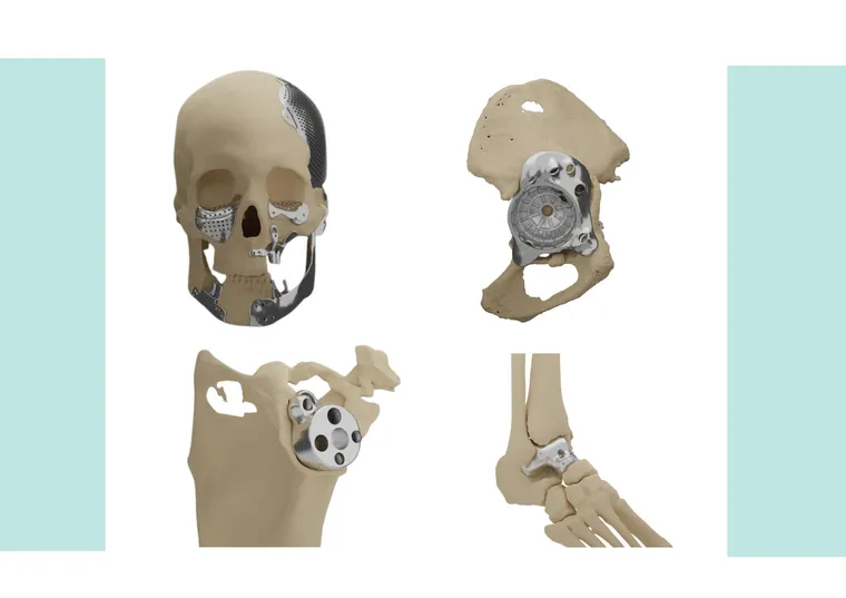 Patient-specific cranial, pelvic, shoulder and ankle implants in situ