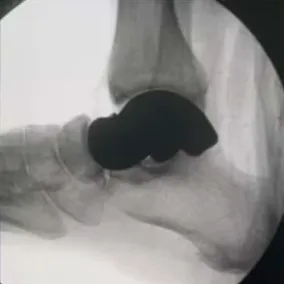 Post-operative radiograph of a total talus replacement