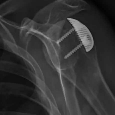 Post-operative radiograph of a patient-specific implant