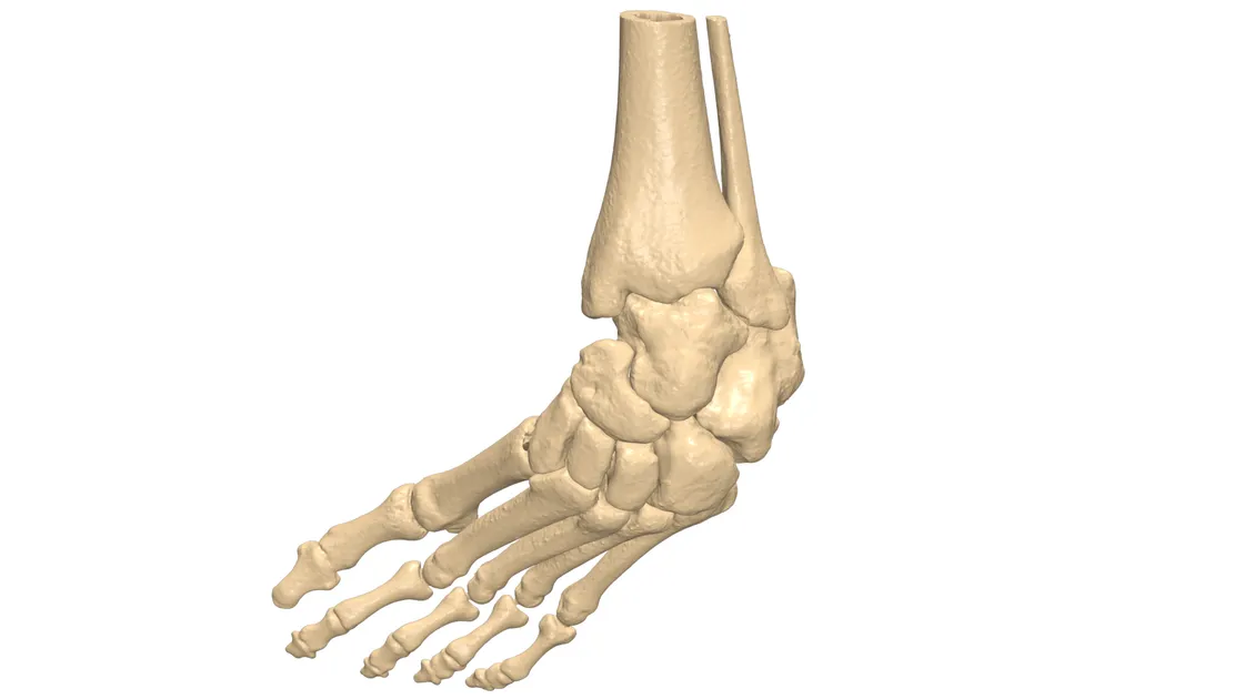 Club foot 3D pre-operative planning model
