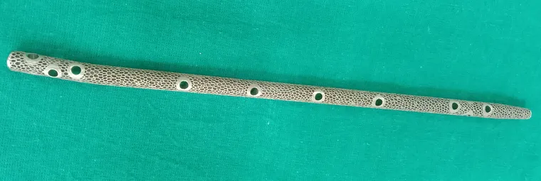 The custom nail and PEKK graft on the operative field