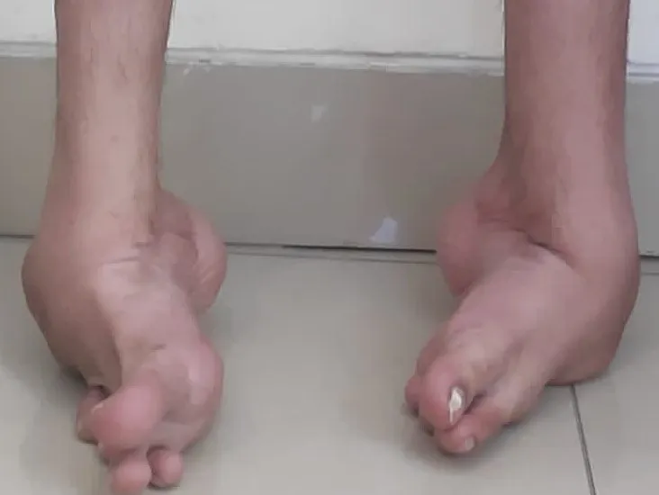 Club foot deformity