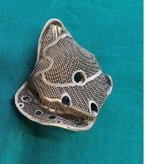 Implant fitted to the patient anatomy