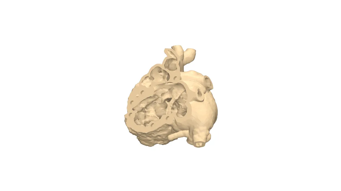 3D-printed resin heart model for congenital heart disease