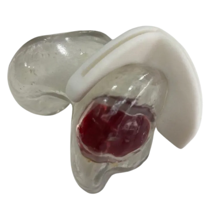 Jig fitted to the patient's distal femur model