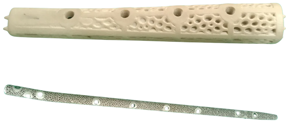 Custom 3D-printed tibial nail and patient-specific PEKK graft