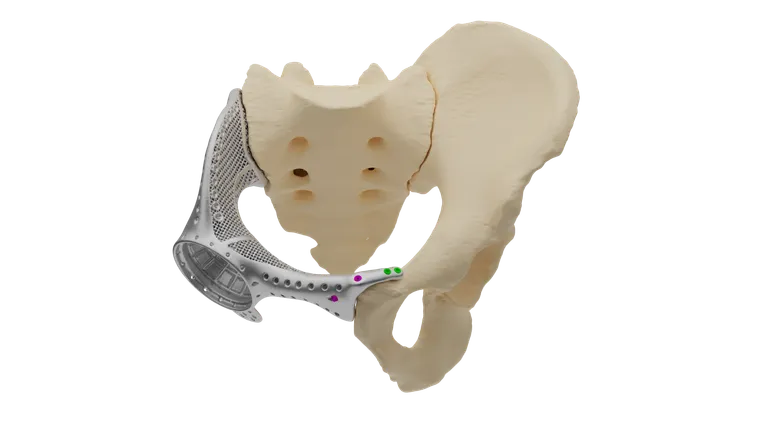 Implant in position