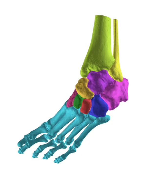 Segmented 3D model of the deformity