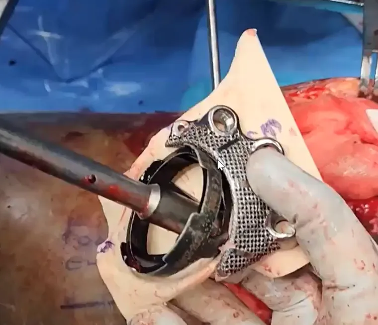 Bose augment fitment intra-operative