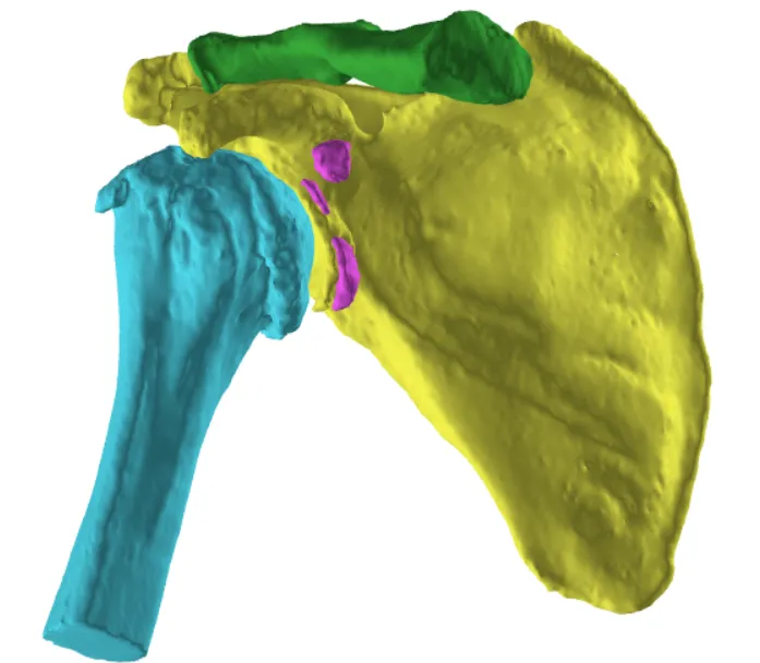 Glenoid inclination and version planning