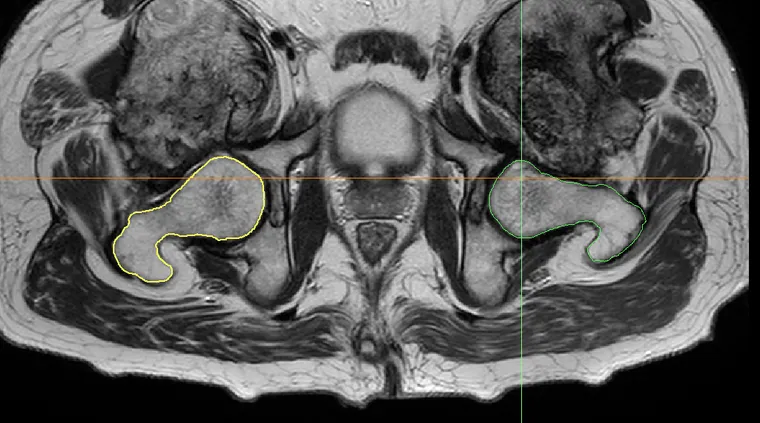 Bilateral heterotopic ossification