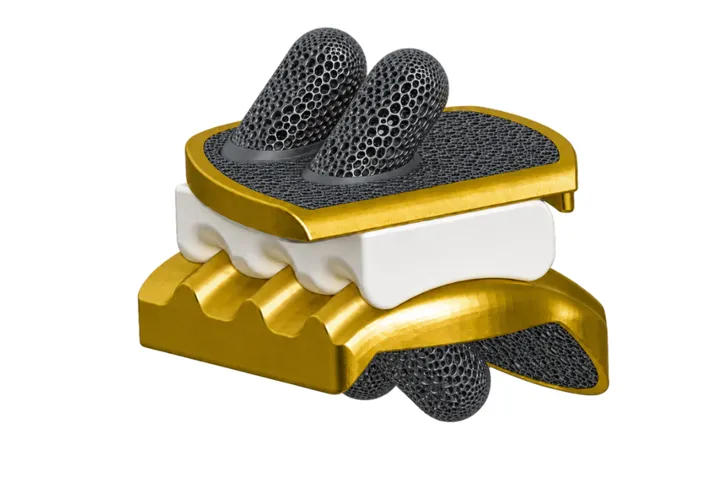 InJoint customised total ankle replacement