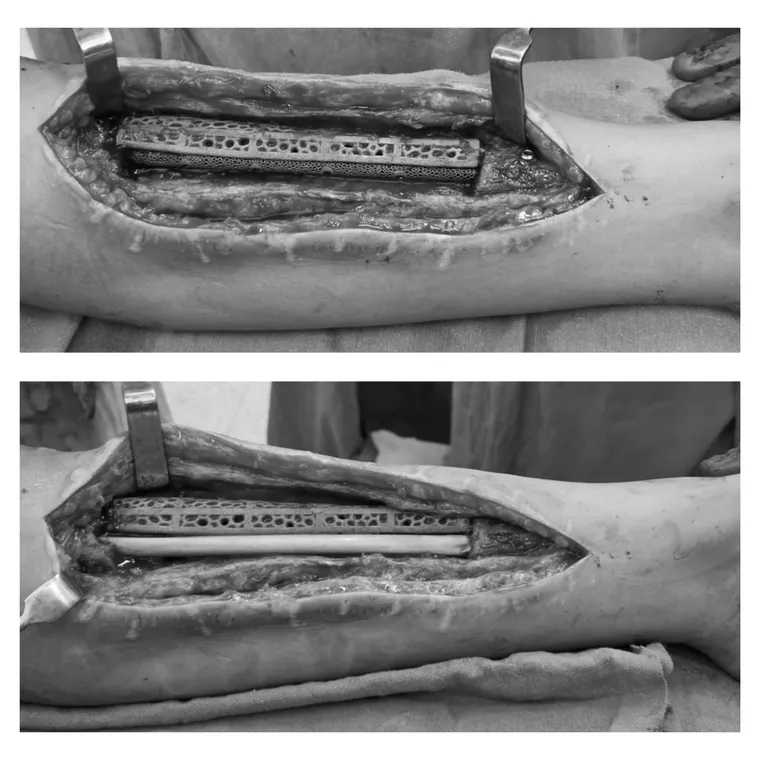 Intra-operative reconstruction of the tibial defect
