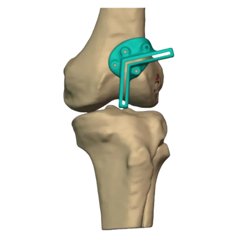 Jig seated on the distal femur, anterior view
