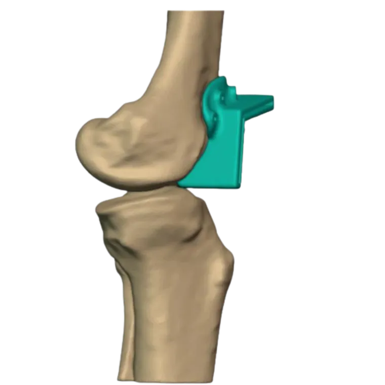 Jig seated on the distal femur, lateral view