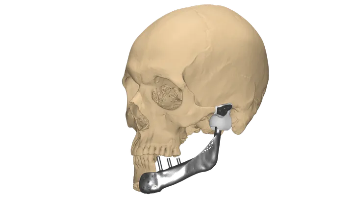 Patient-specific mandibular implant