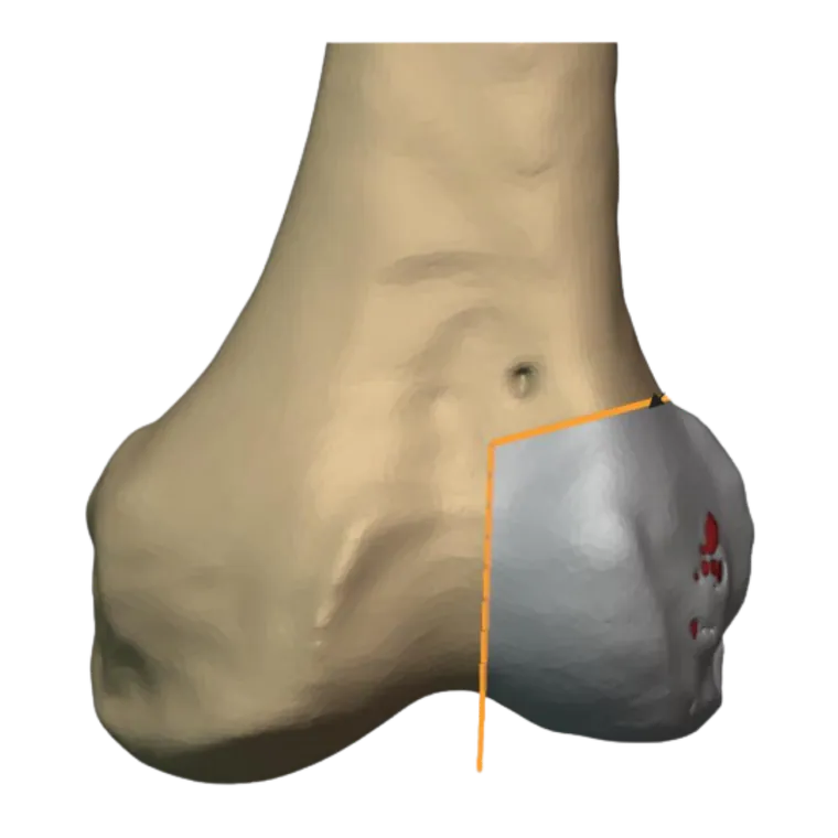 Planned osteotomy planes and resection margins