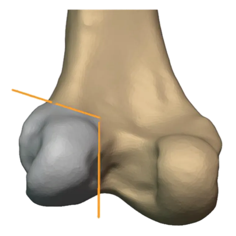 Resection segment, second view