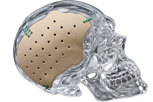 Customised PEKK cranial implant