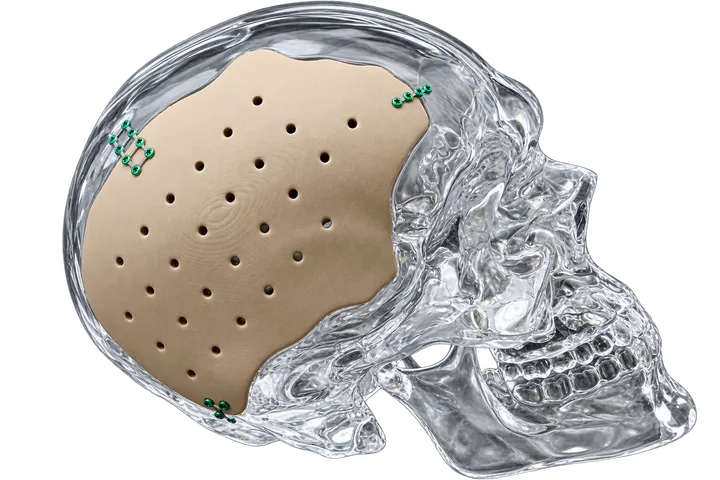 Customised PEKK cranial implant
