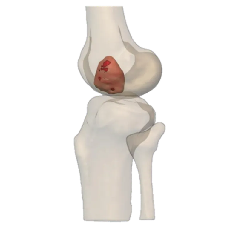 Tumour extent in the distal femur