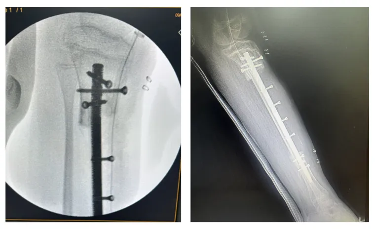Post-operative imaging of the reconstructed tibia