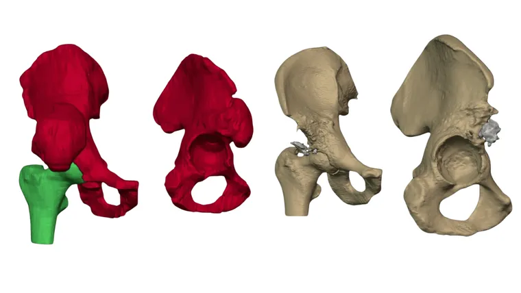 Extent of iliac bone involvement