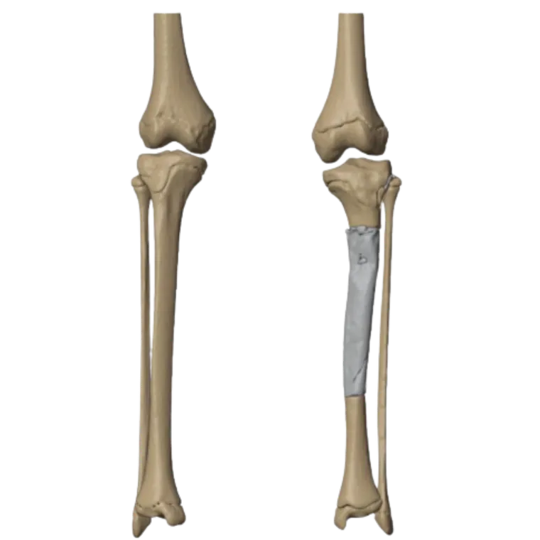 Extent of bone involvement