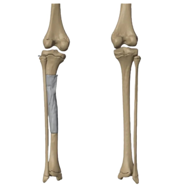 Segmental defect of the tibial shaft