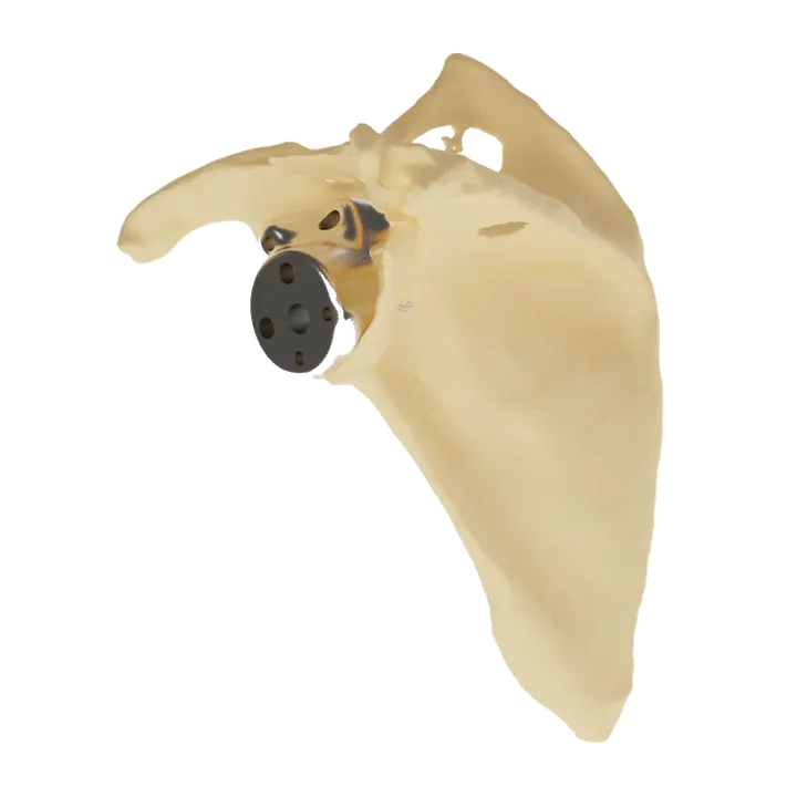 Orthopaedics patient-specific implant, view 2 of 3