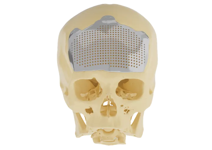 Cranio-Maxillofacial patient-specific implant, view 1 of 2