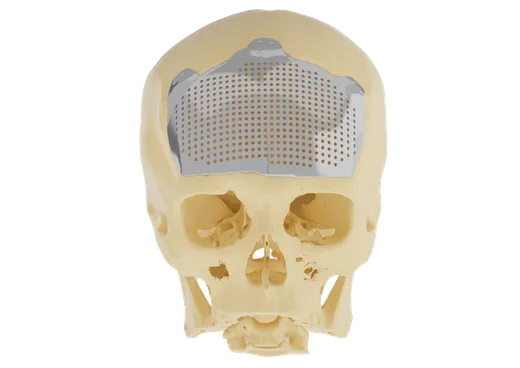 Customised titanium cranial implant