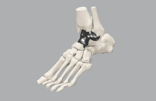 Patient-specific total talus replacement
