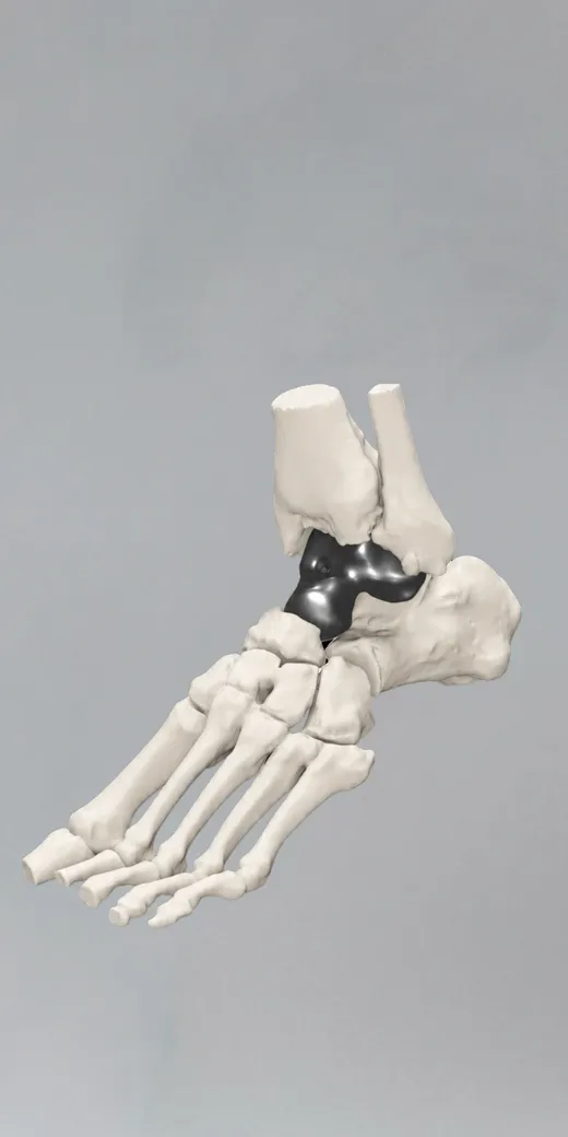 Total Talar Replacement