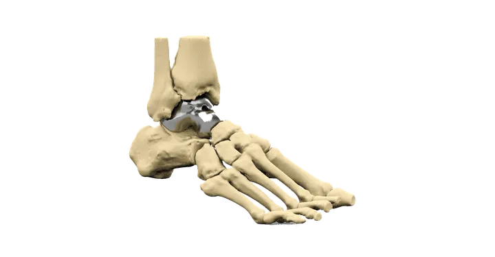 Orthopaedics patient-specific implant, view 3 of 3