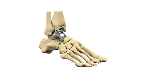 Total Talar Replacement