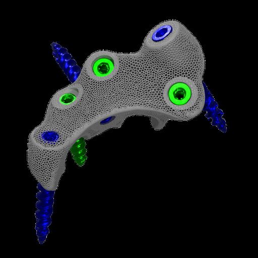 Divergent docking screws leaving the augment in multiple planes
