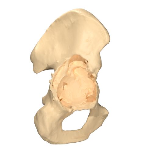 Segmented acetabular defect from the patient CT