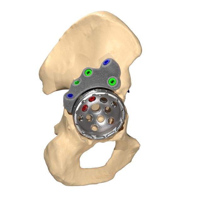 Augment unitised with a highly porous cup