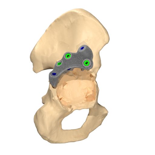 Custom CCD augment seated on the defect