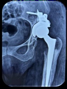 Post-op radiograph of a CCD augment construct