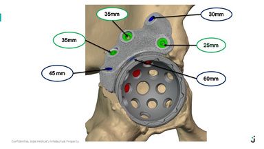 Screw lengths supplied with the pre-op plan