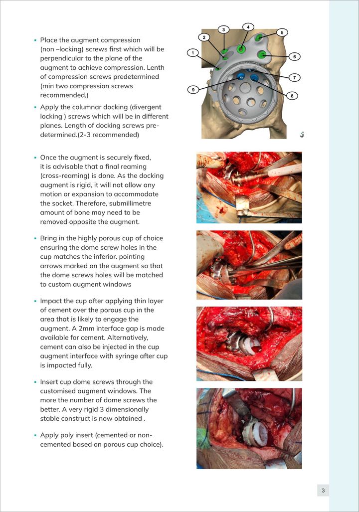 Bose Augment surgical technique, page 3