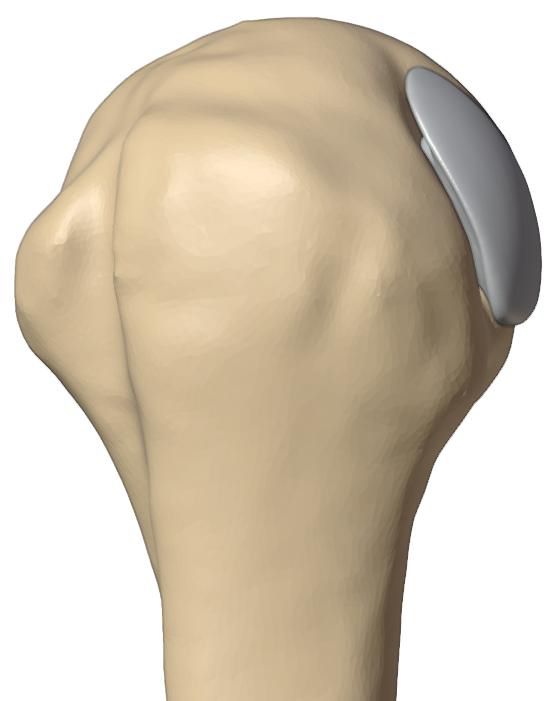 Restored articular contour, lateral view