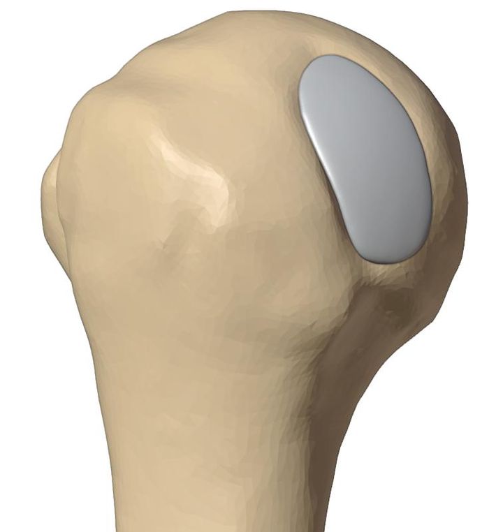 Implant seated in the defect
