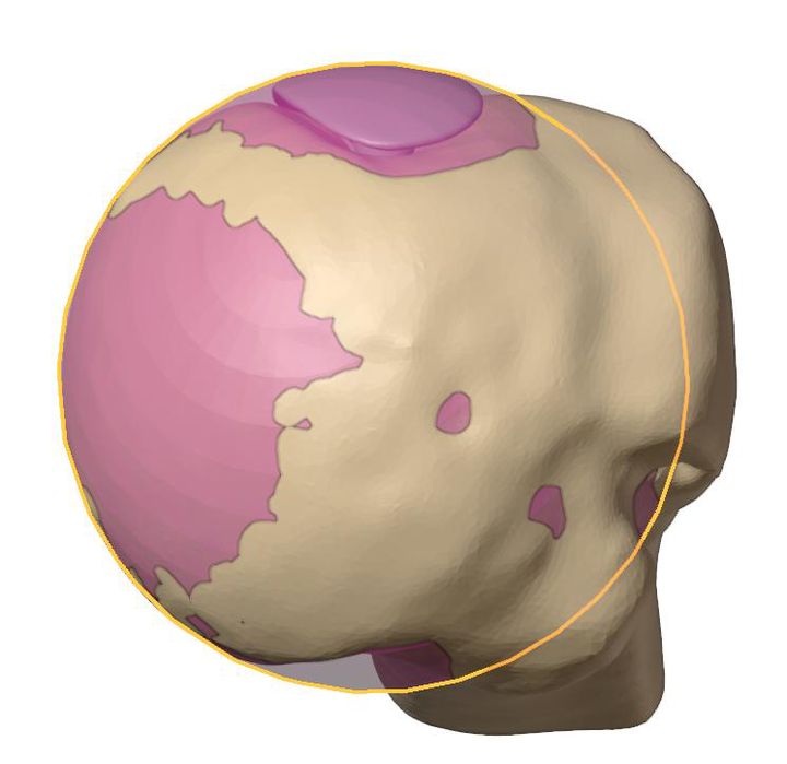 Implant contained within the Iannotti circle