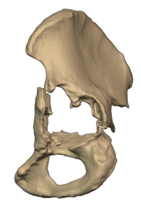 Planned post-op state