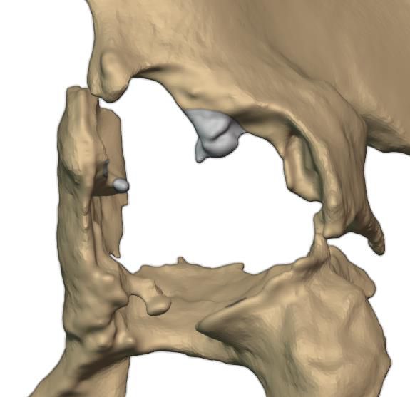 Bone to be trimmed