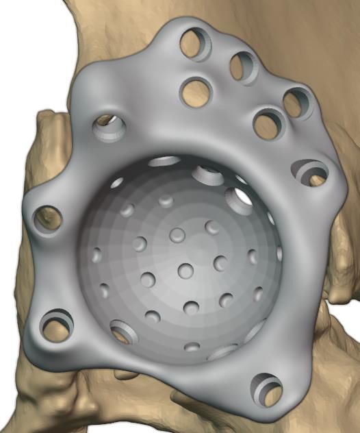 Cage geometry with screw hole plan