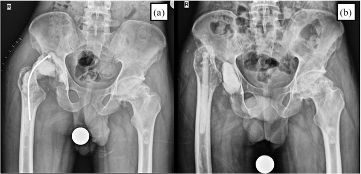 Fig 1 — staged revision with antibiotic cement spacer in situ